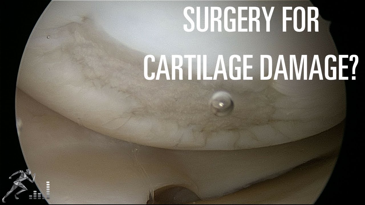Do you need surgery for cartilage damage in your knee?