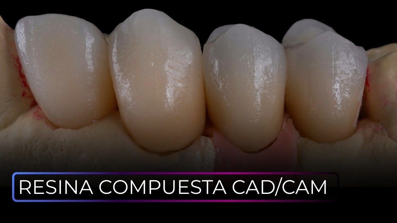 #MAXIMICESUPOTENCIAL | Resinas compuestas CAD CAM | Milko Villarroel
