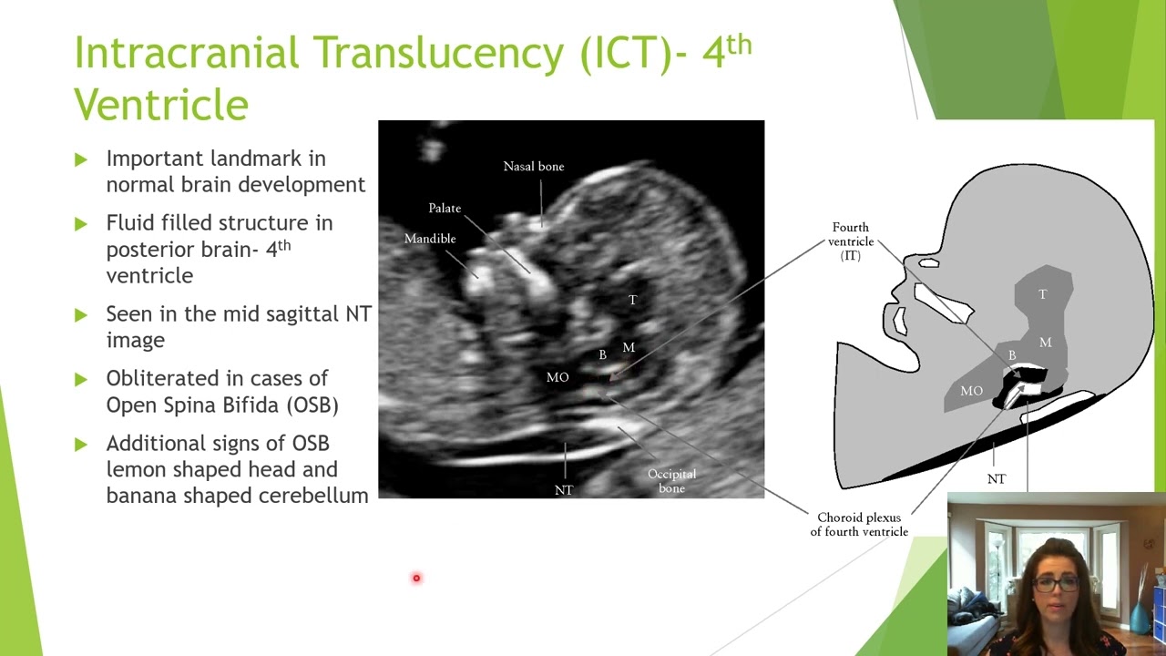 Beyond the &lsquo;Nuchal&rsquo;- Getting the Most from the 11-14 Week Ultrasound | Michelle Sutherland | AFIC