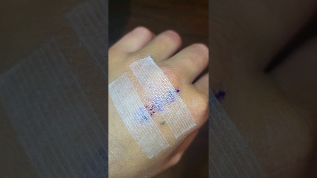 Ganglion cyst surgery update experience🏥  #surgeryexperience #ganglioncyst #healingjourney