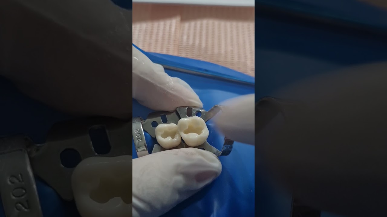 PROTOCOLO DE TRABAJO DEL IONOMERO DE VIDIRIO DE AUTOCURADO Y FOTOCURADO