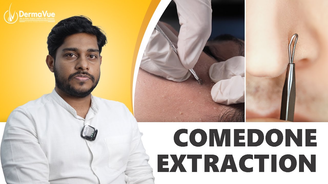 Understanding and Treating Blackheads and Whiteheads: No more Comedones 
