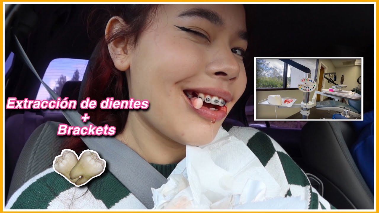 ME QUITAN 4 DIENTES Y ME PONEN BRACKETS *vlog*!