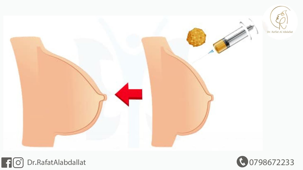 عملية تكبير الثدي بالدهون الذاتية  حقن الدهون الذاتي لتكبير الصدر