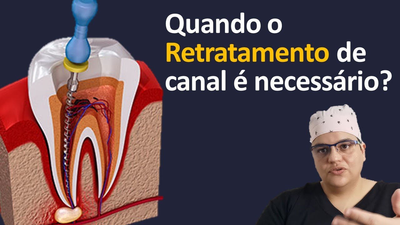 Retratamento de canal quando é necessário fazer | Dra Bianca Rosa | Clínica Bianca Rosa