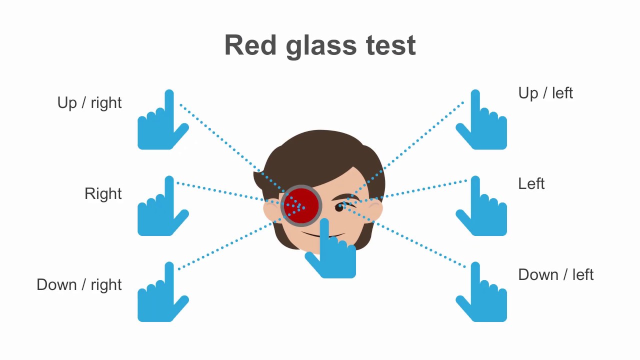Extraocular Movements: Analyzing CN 3, 4, and 6 Abnormalities