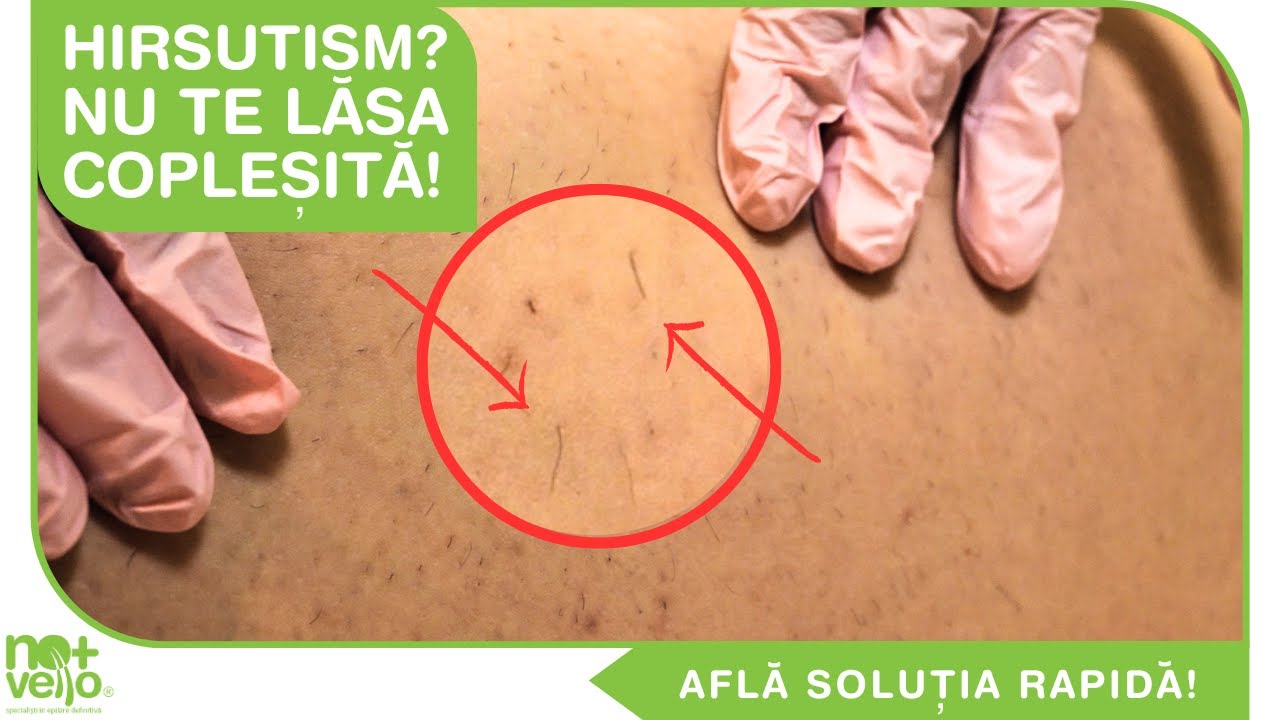 Hirsutism: Descopera TRATAMENTUL pentru Pilozitatea Excesiva