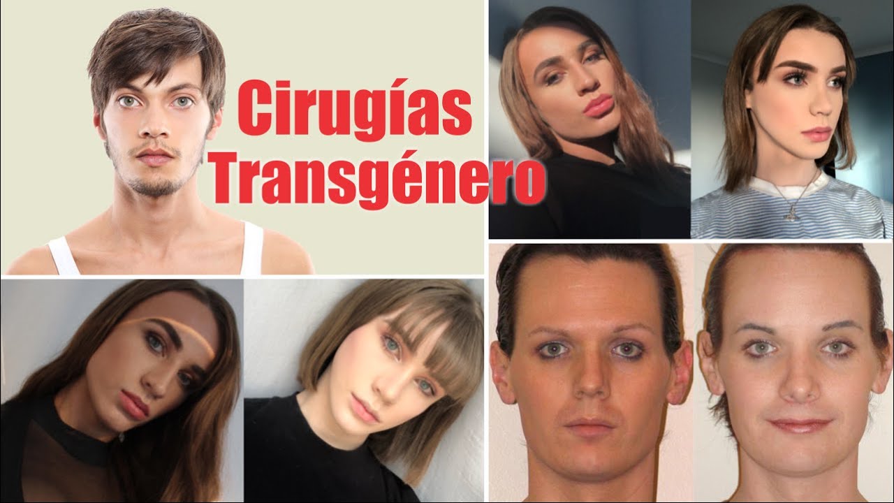 CIRUGíA TRANGéNERO 🏳️‍🌈 FeminiZación o MasculiniZación 😨 Cambio de seXo 🔴 Dr ALBERTO CALVO QUIROZ