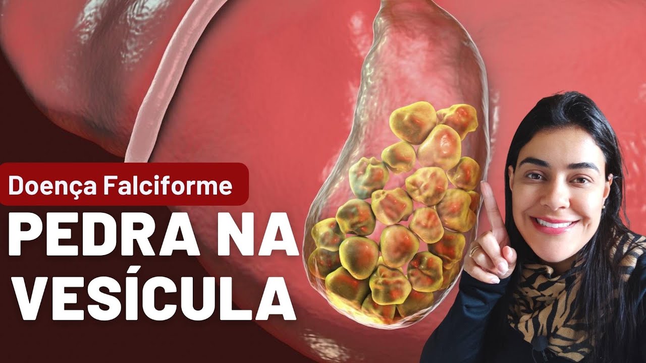 Pedra na VESÍCULA e Anemia Falciforme: o que fazer e como foi minha cirurgia? | Cálculo biliar