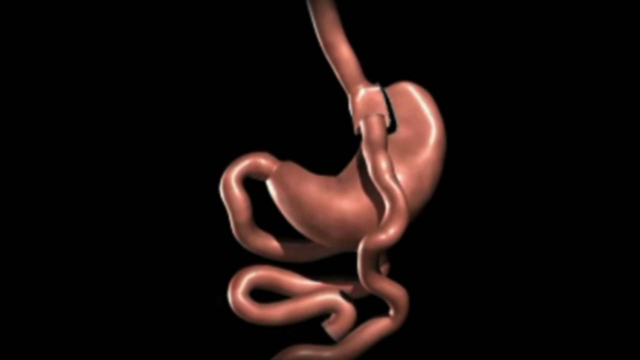 Magenbypass Operation technisch erkl&auml;rt