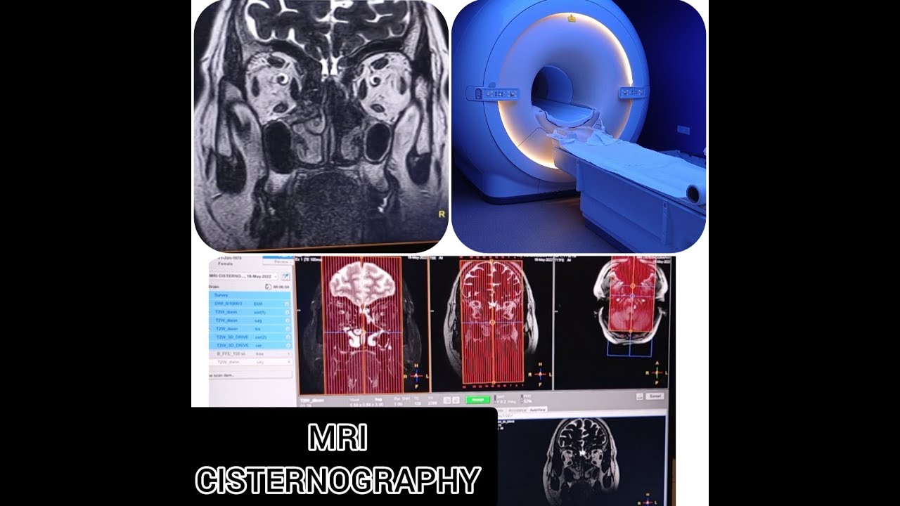 MRI CISTERNOGRAPHY II PLANNING II POSITIONING II SEQUENCE DETAILS
