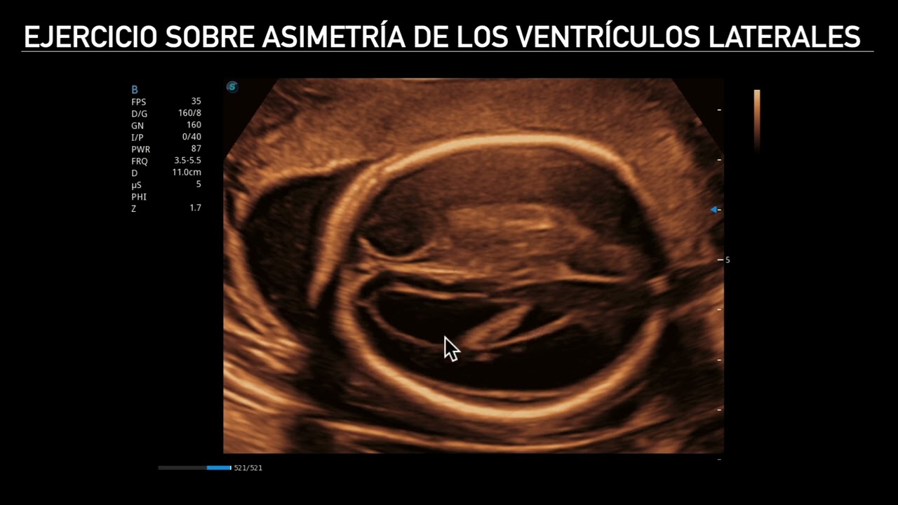 Neurosonografía Fetal: Ejercicio de asimetría de ventrículos laterales