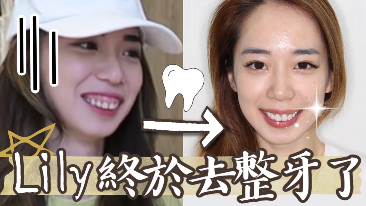 終於去整牙🦷😁陶瓷美白貼片經驗分享 // Chen Lily