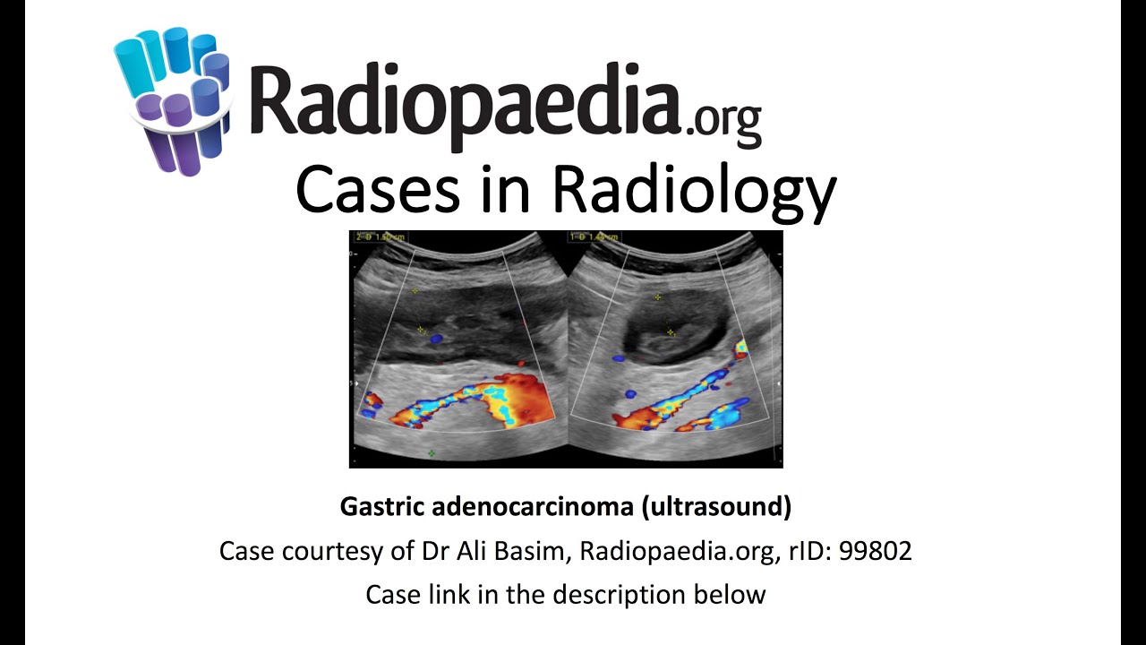 Gastric adenocarcinoma (ultrasound) (Radiopaedia.org) Cases in Radiology