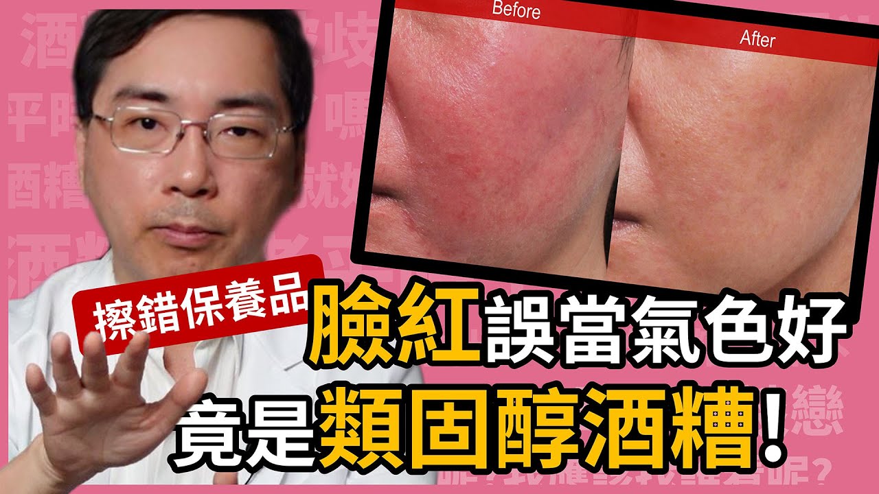 類固醇酒糟！臉紅誤當氣色好，竟是擦錯含類固醇的保養品惹禍！讓林政賢醫師來跟大家解釋什麼是類固醇酒糟。