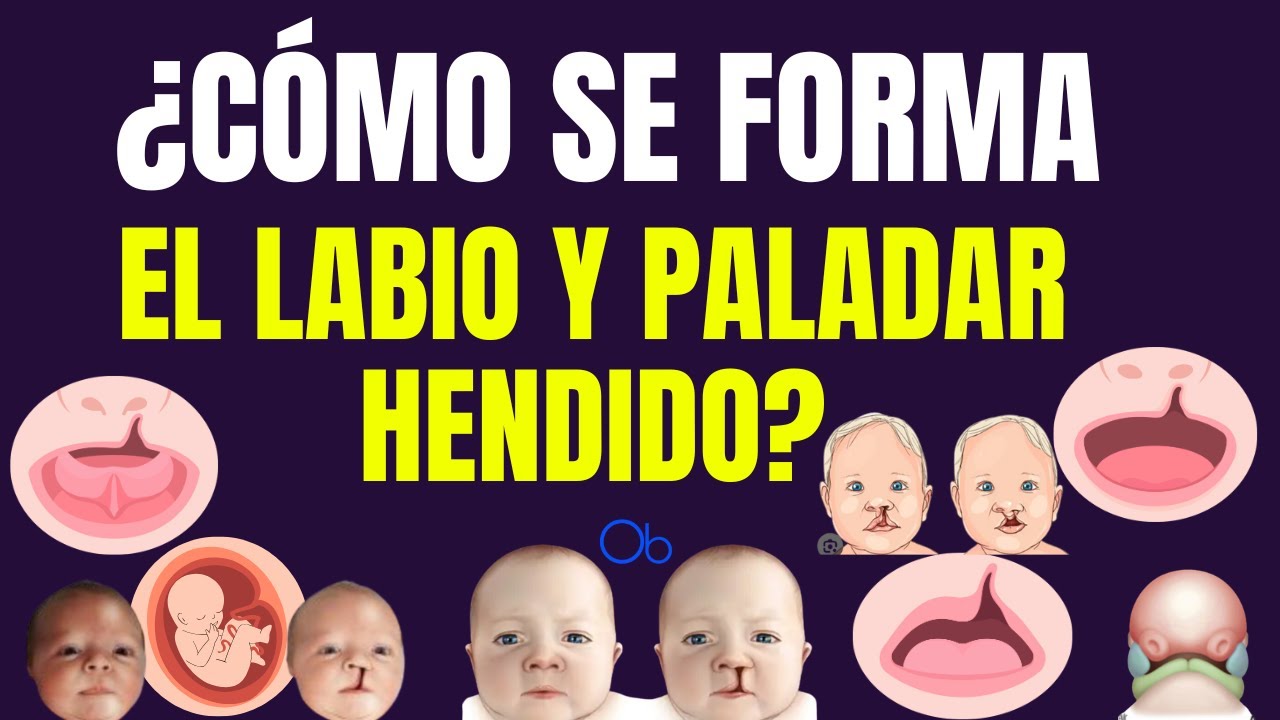 ¿Cómo se forma el labio y paladar hendido?