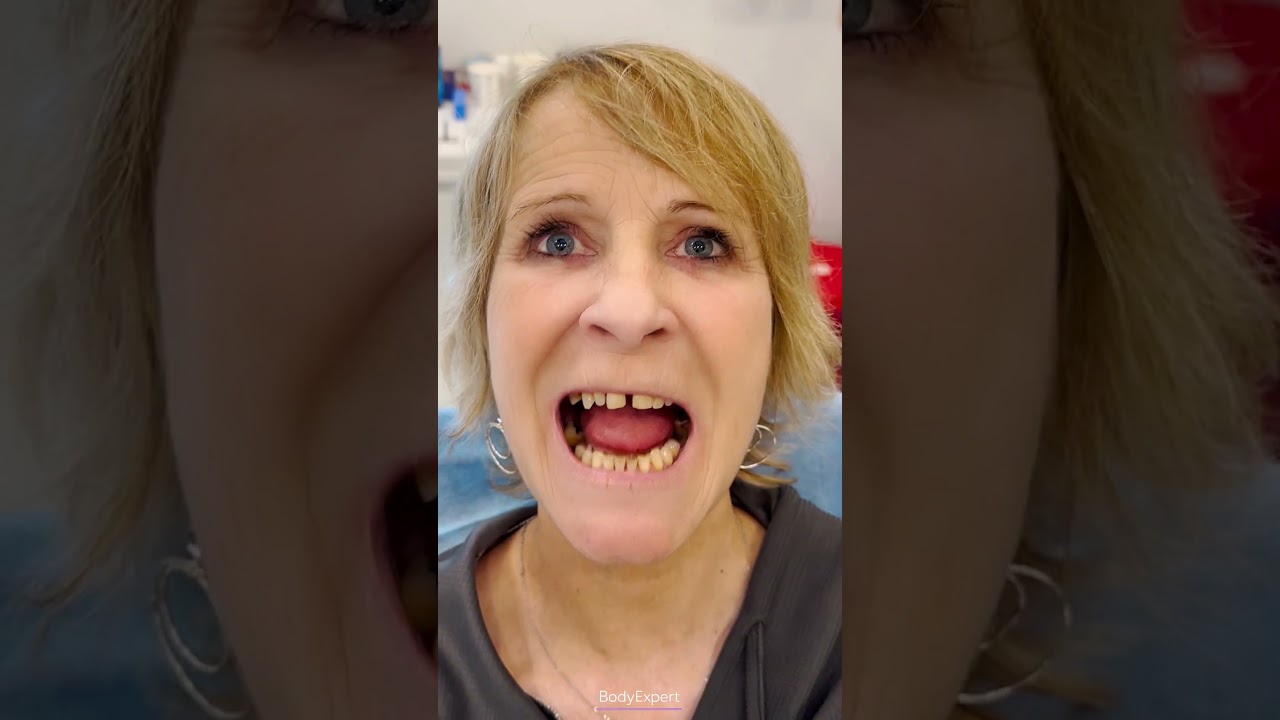 DENTAL IMPLANTS IN TURKEY | 🦷 Nadia's testimony: 3 implants + bone graft + 24 crowns | BODYEXPERT