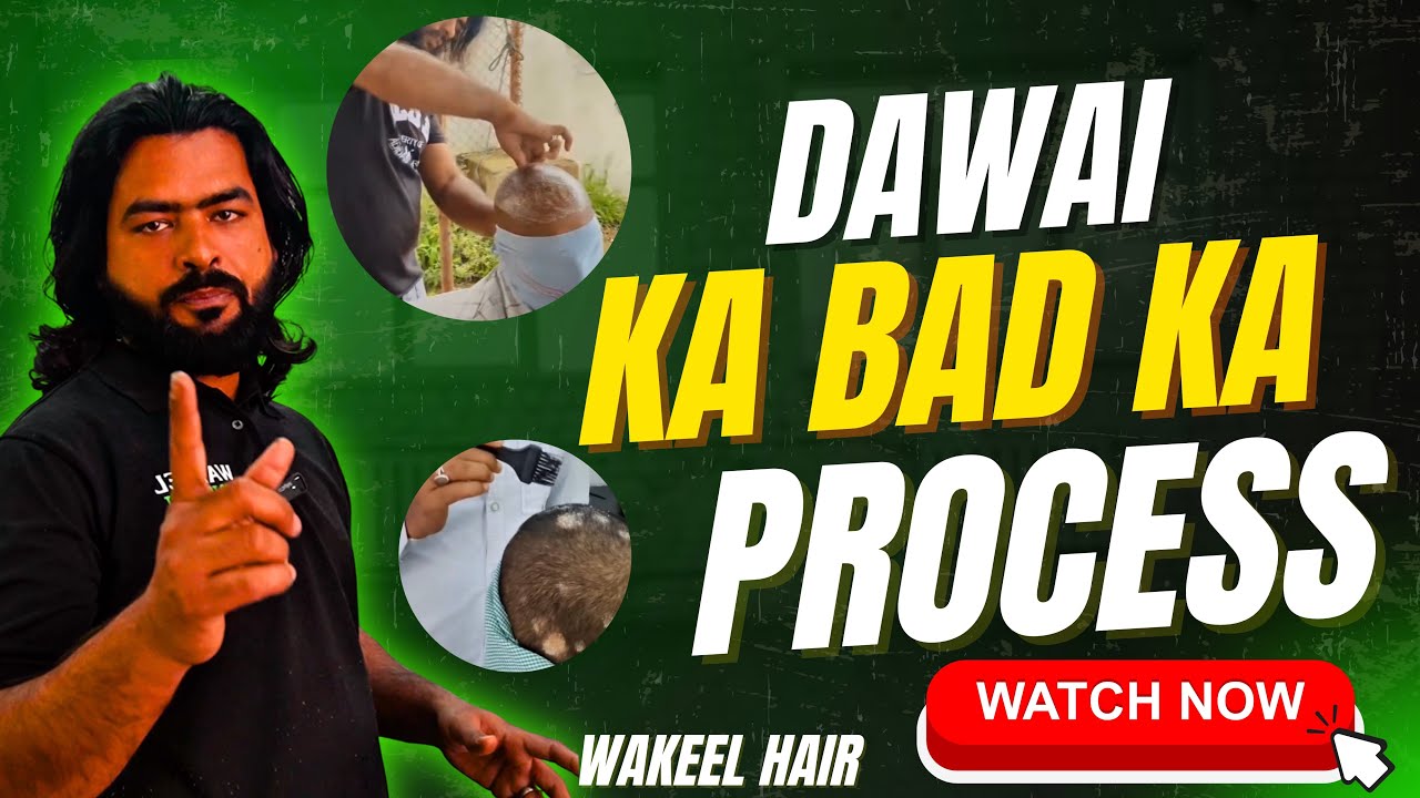 Dawai Ke Baad Galti Mat Karo ❌ | Wakeel Hair Treatment Complete Care Process | Oil, Do & Don&rsquo;t #wak 