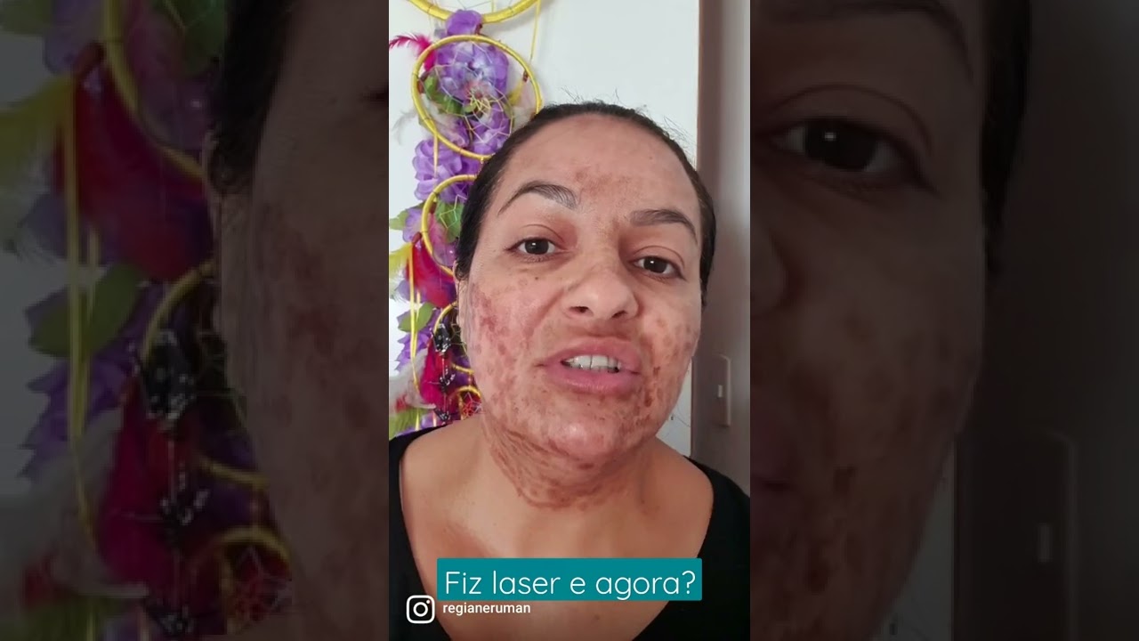 2 dias pós laser. Ansiosa pela resultado. Como diminuir a sensibilidade pós laser?