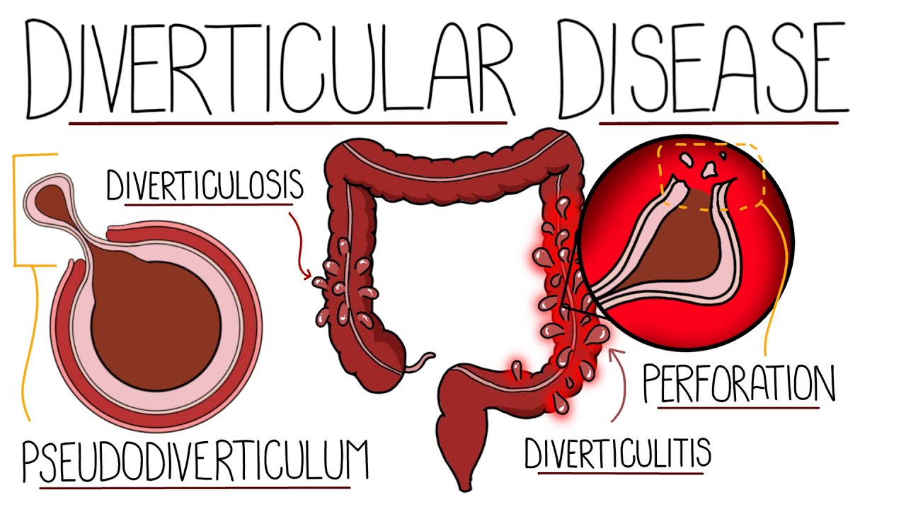 Understanding Diverticular Disease (Diverticulosis and Diverticulitis)