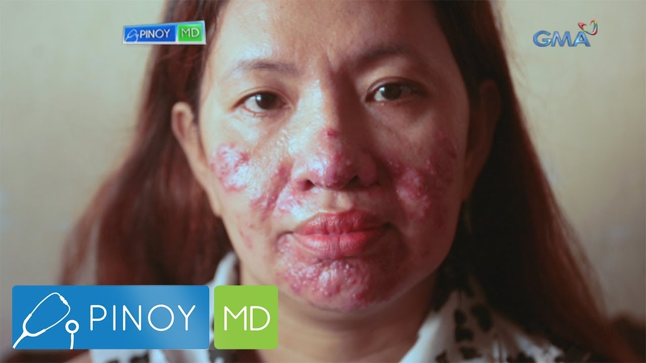 Pinoy MD: Sanhi ng adult acne sa mga babae, tinalakay sa ‘Pinoy MD’