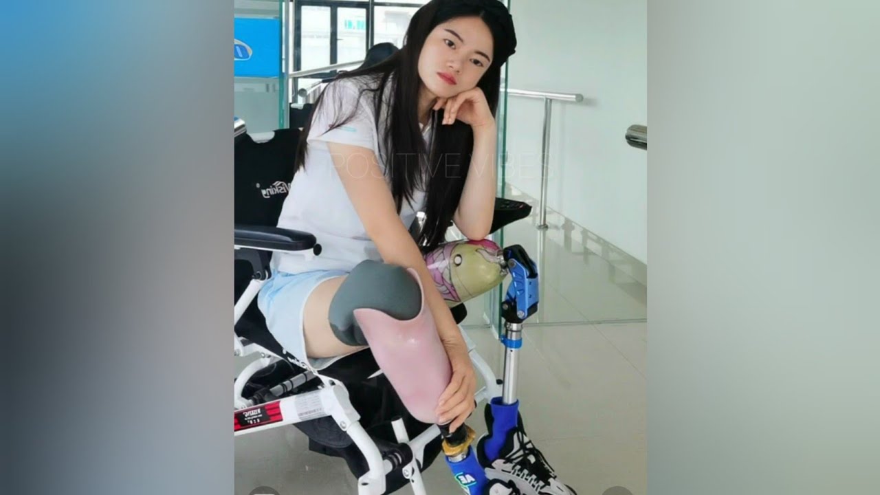 GAIT TRAINING WITH NEW BK PROSTHETIC LEG