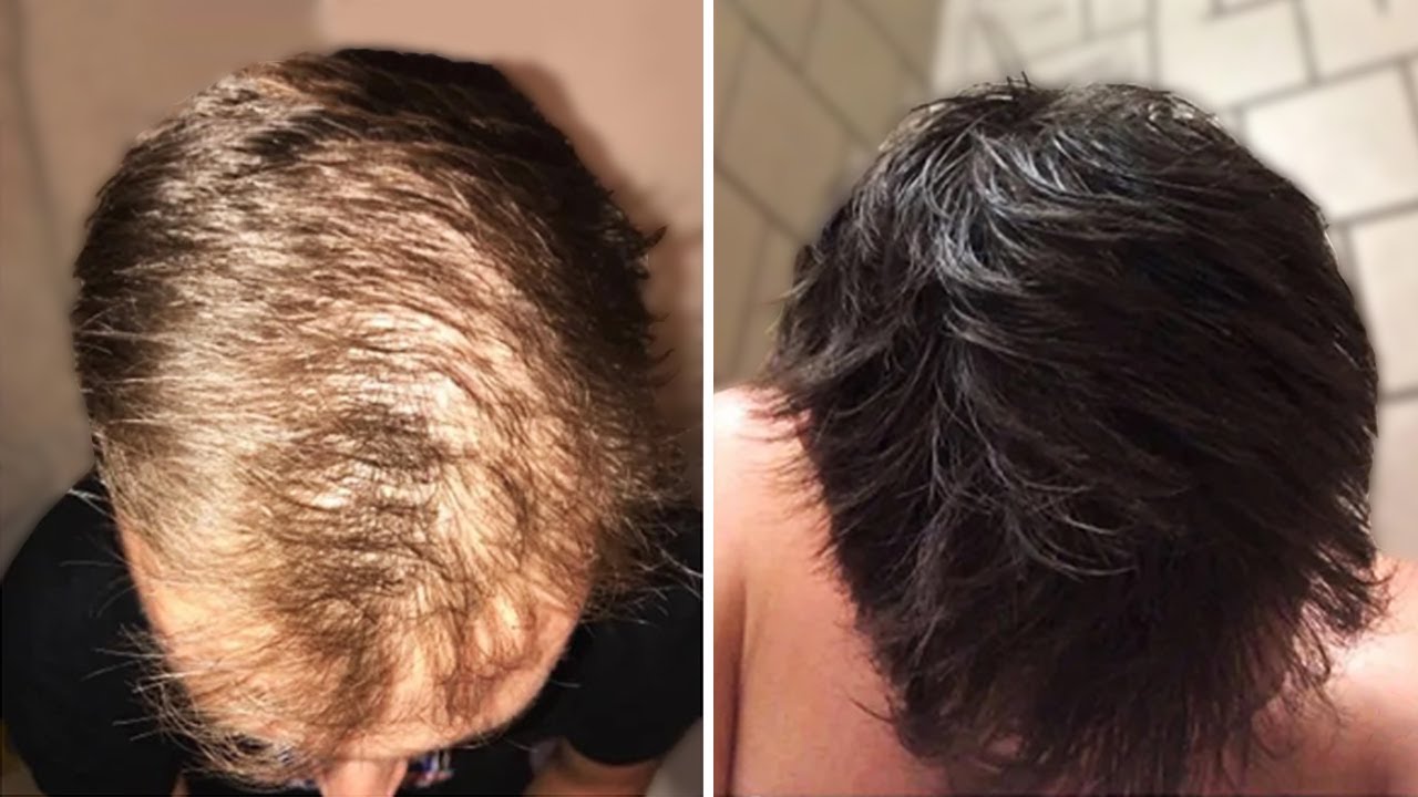 Su Pelo Vuelve De La Tumba En 4 Meses