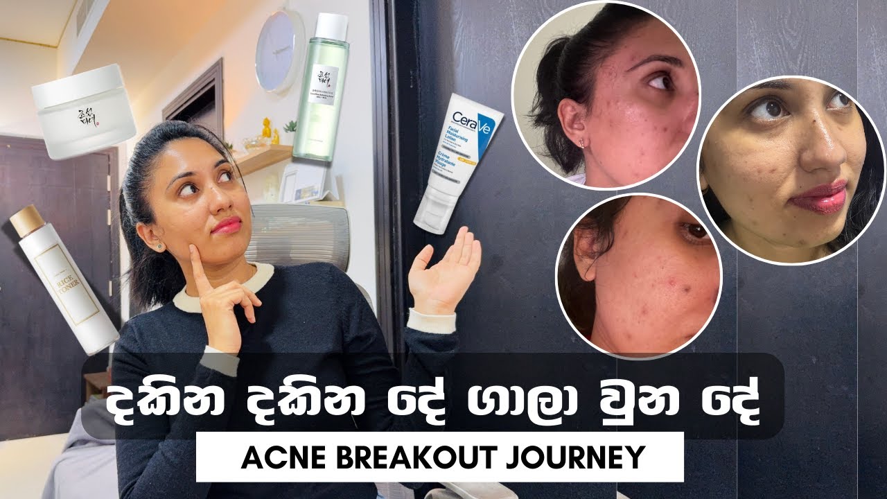 දකින දකින දේ ගාලා වුන දේ 🥲| මේවා ගානවනම් ඔයාලත් පරිස්සමින්‼️| My Acne Breakout Journey |Sinhala Vlog