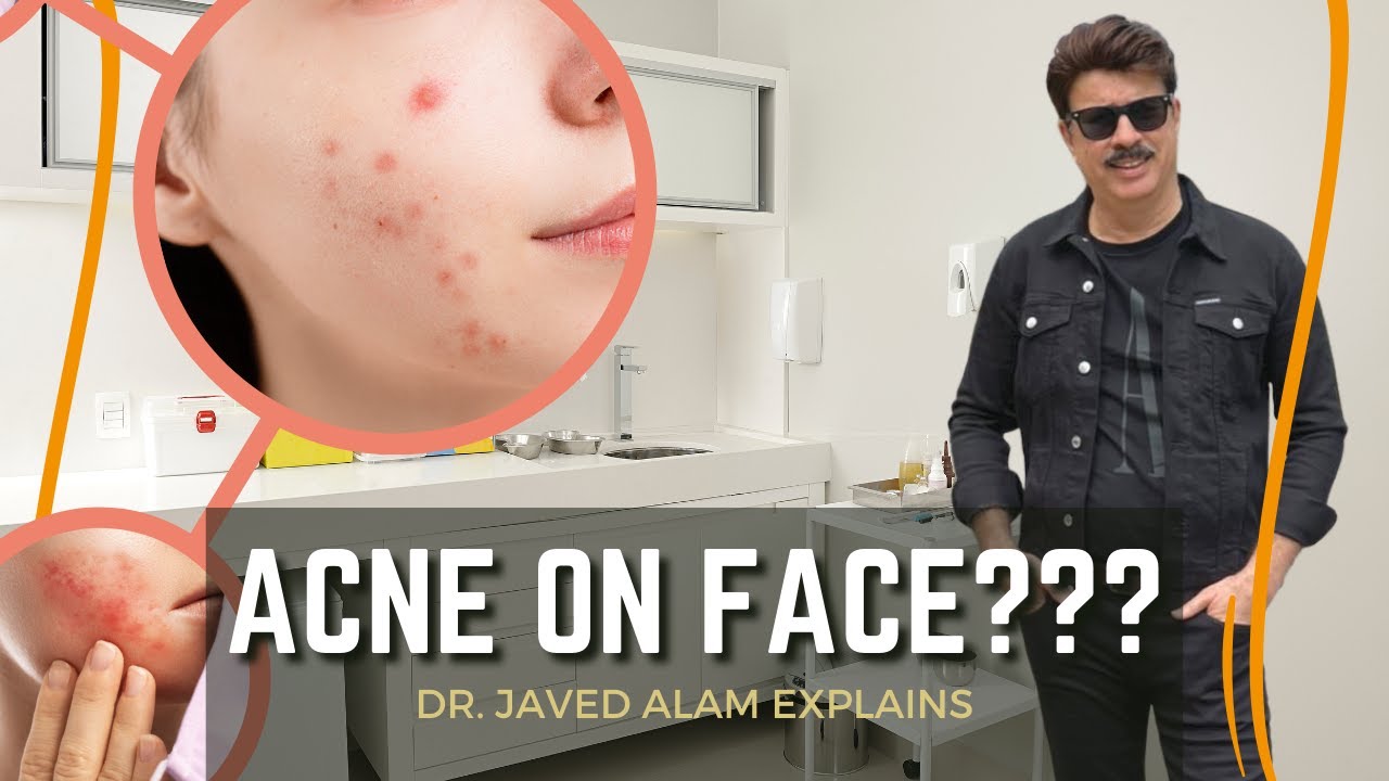 How Can Acne Be Cured? | How Acne Affects our Social Lives | Dr. Javed Alam Explains #acne #skincare