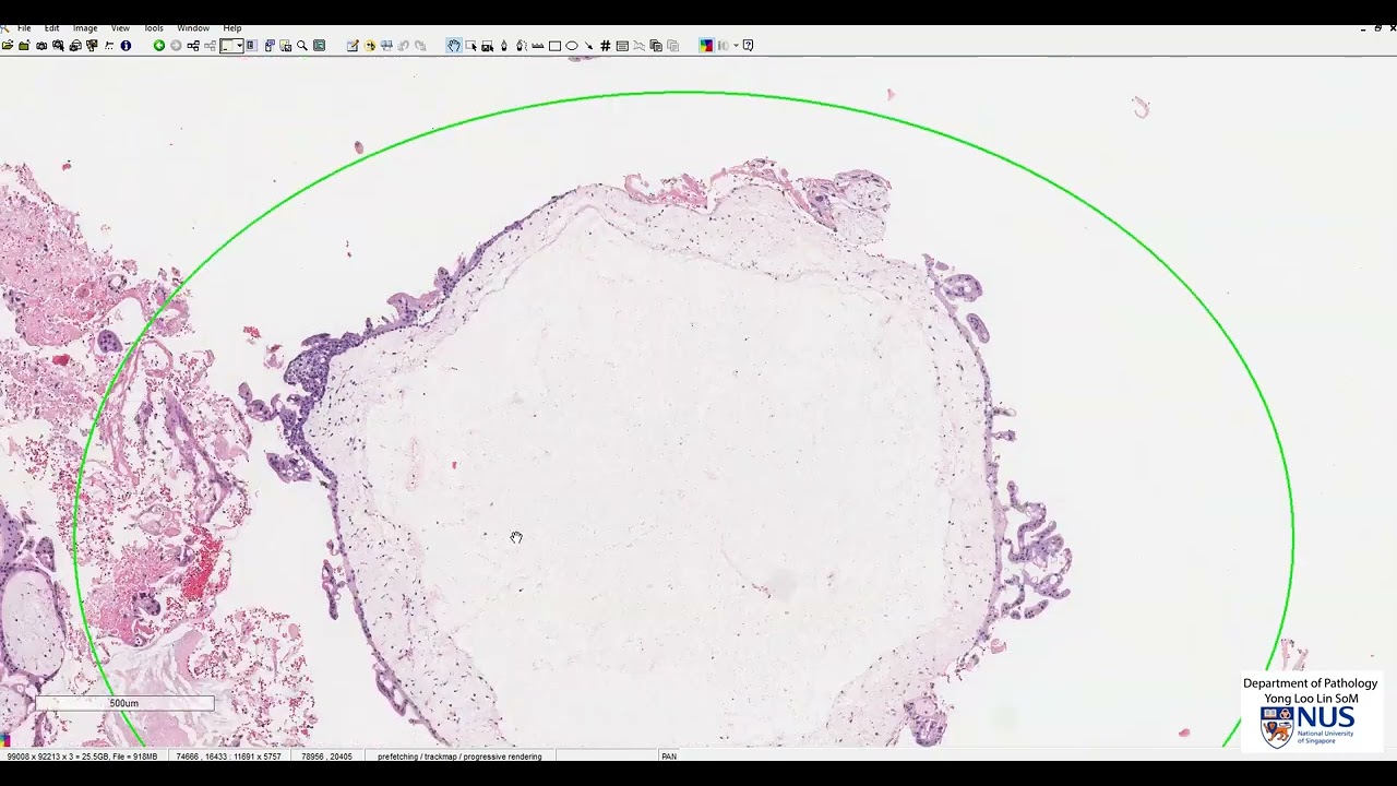 Uterus: Hydatidiform mole Microscopy - Talking slide