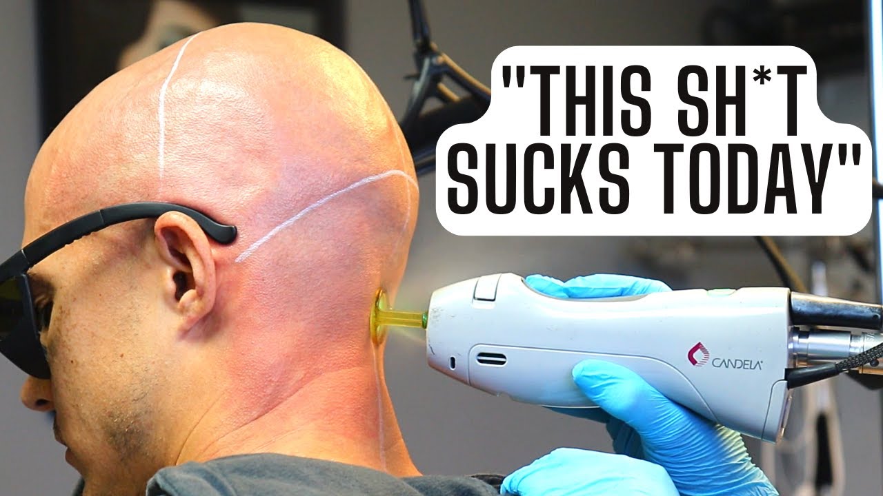 5TH SESSION OF SCALP LASER HAIR REMOVAL