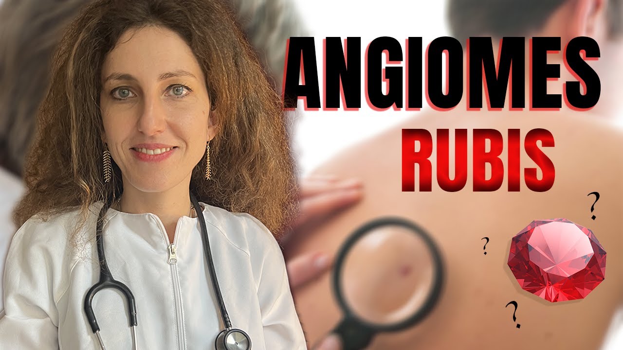 Les ANGIOMES RUBIS, c'est grave ? Comment les enlever ?