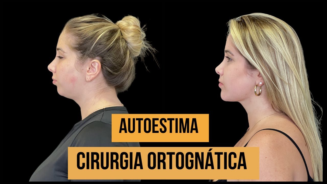 Transformação da face - Cirurgia Ortognática