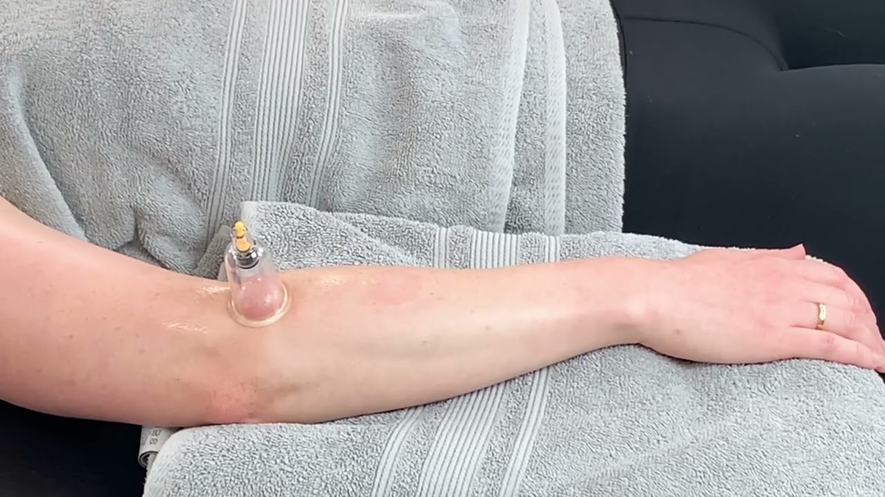 Myofascial Cupping - wrist extensors￼