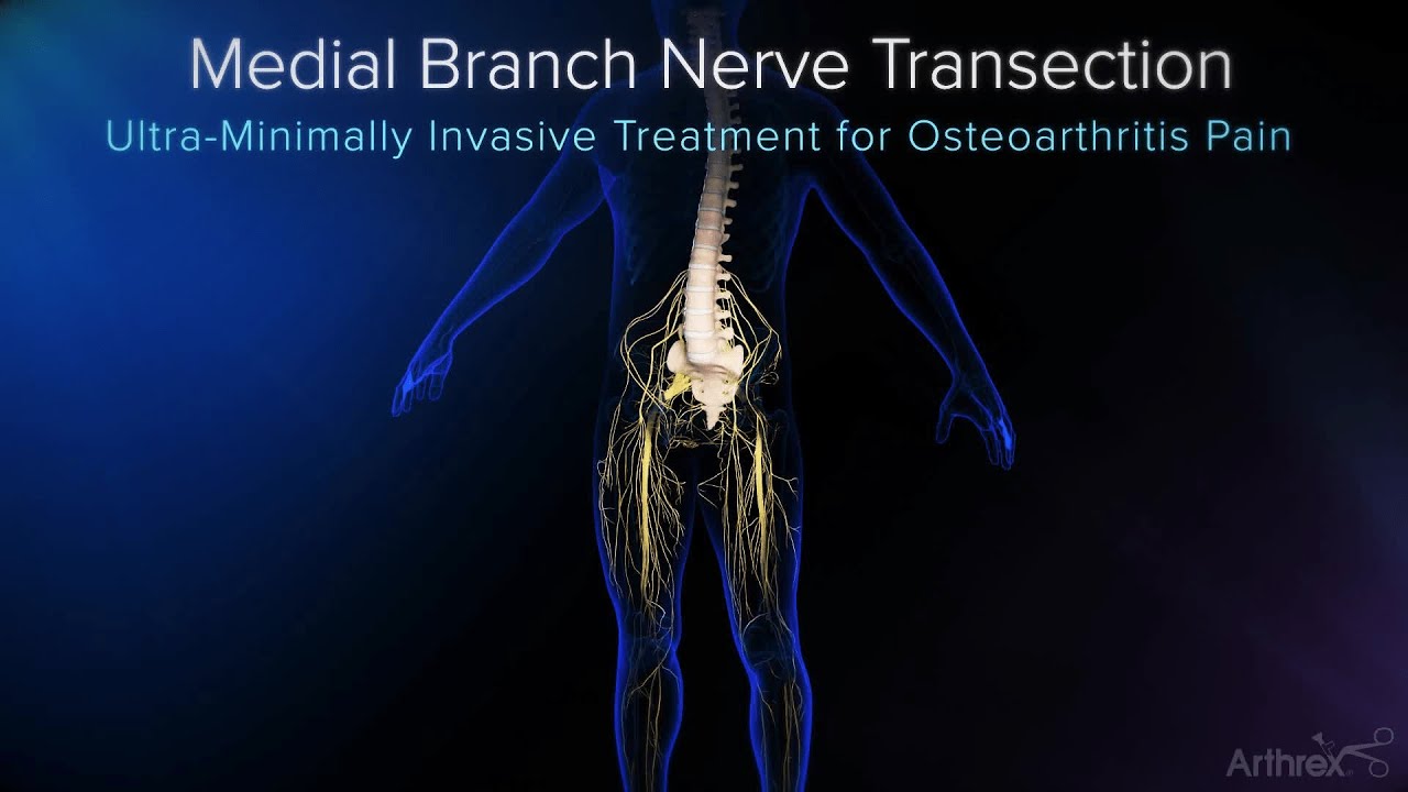 Endoscopic Medial Branch Nerve Transection