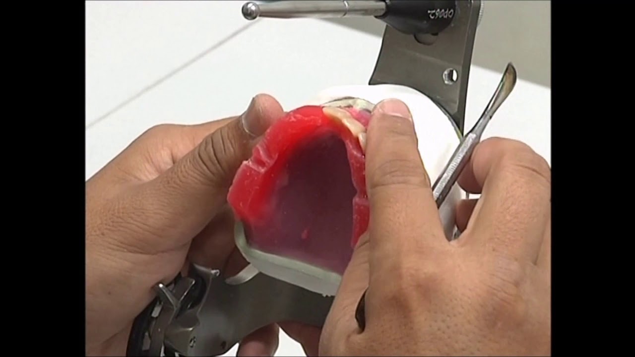 COMPLETE DENTURE: 8. Teeth Setting Up - Anterior Maxillary Teeth
