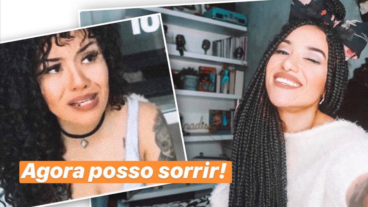 CORRIGI MEU PROBLEMA FACIAL - TIREI O APARELHO (MORDIDA CLASSE 3)