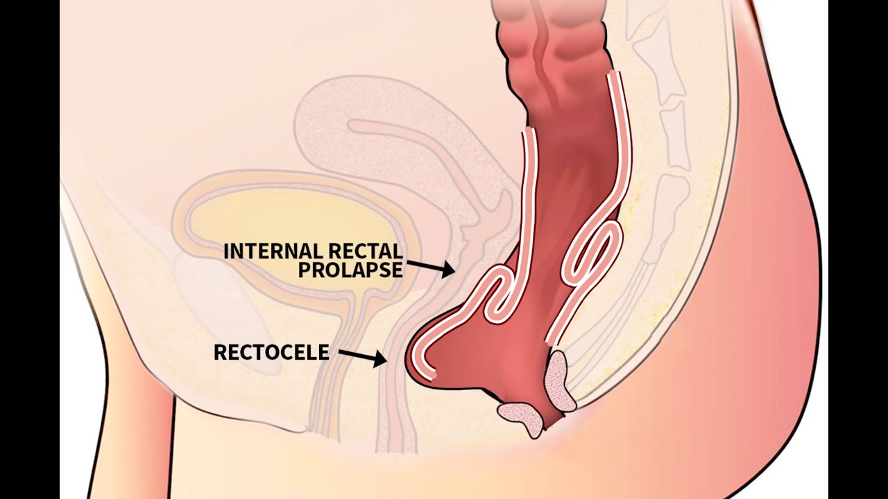 Anima&ccedil;&atilde;o sobre prolapso retal e retocele Rectal Prolapse Rectocele  PORTUGUESE