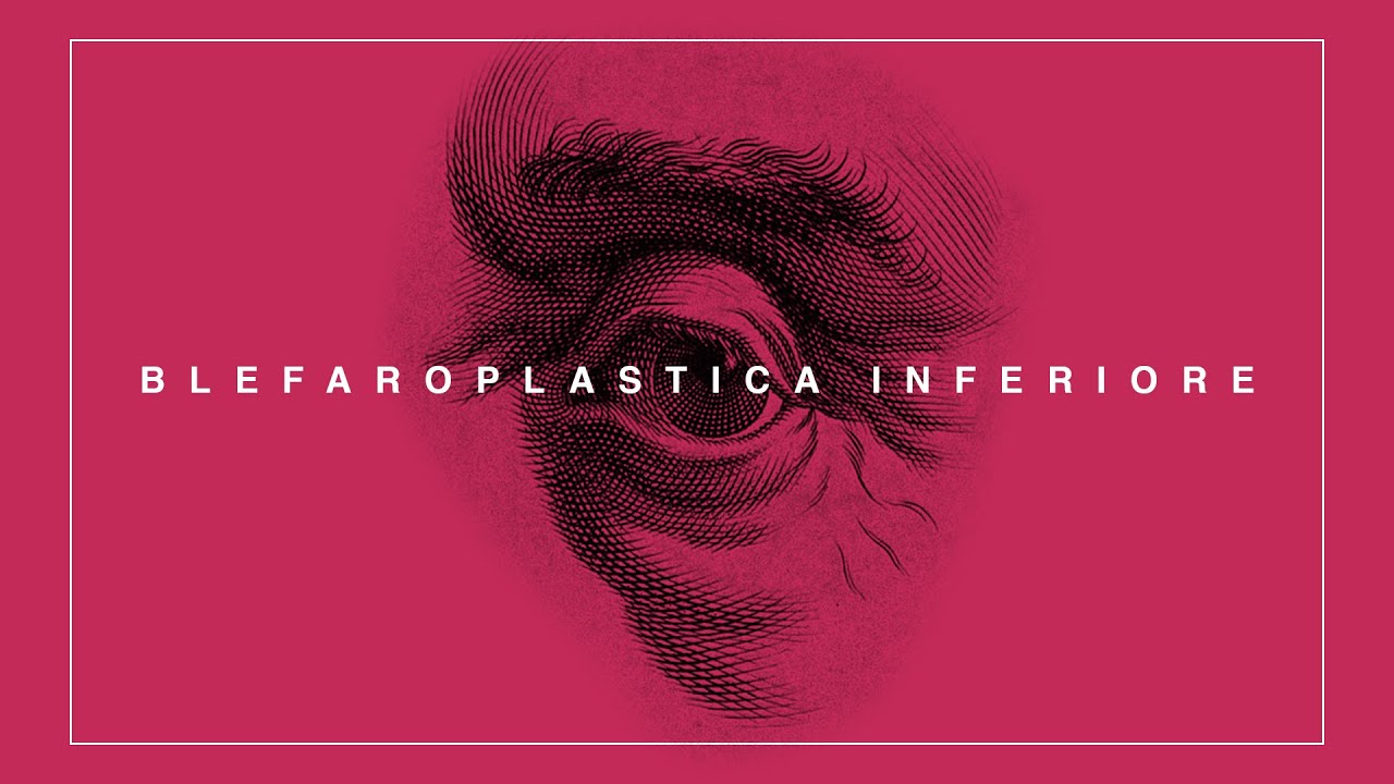 Pillole di Plastica: BLEFAROPLASTICA INFERIORE. Risolviamo le borse sotto gli occhi!