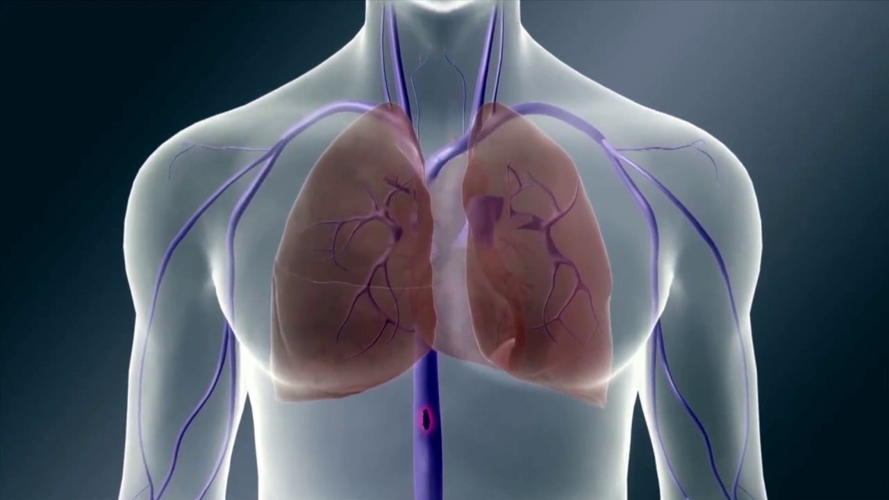25'te 1- Pulmoner Emboli nedir?