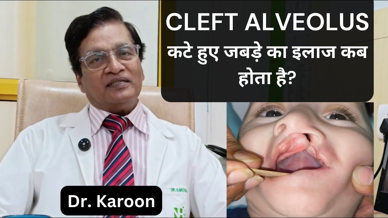 कटे हुए जबड़े (Cleft Alveolus) का इलाज कब होता है | Dr Karoon | Cleft Lip and Palate
