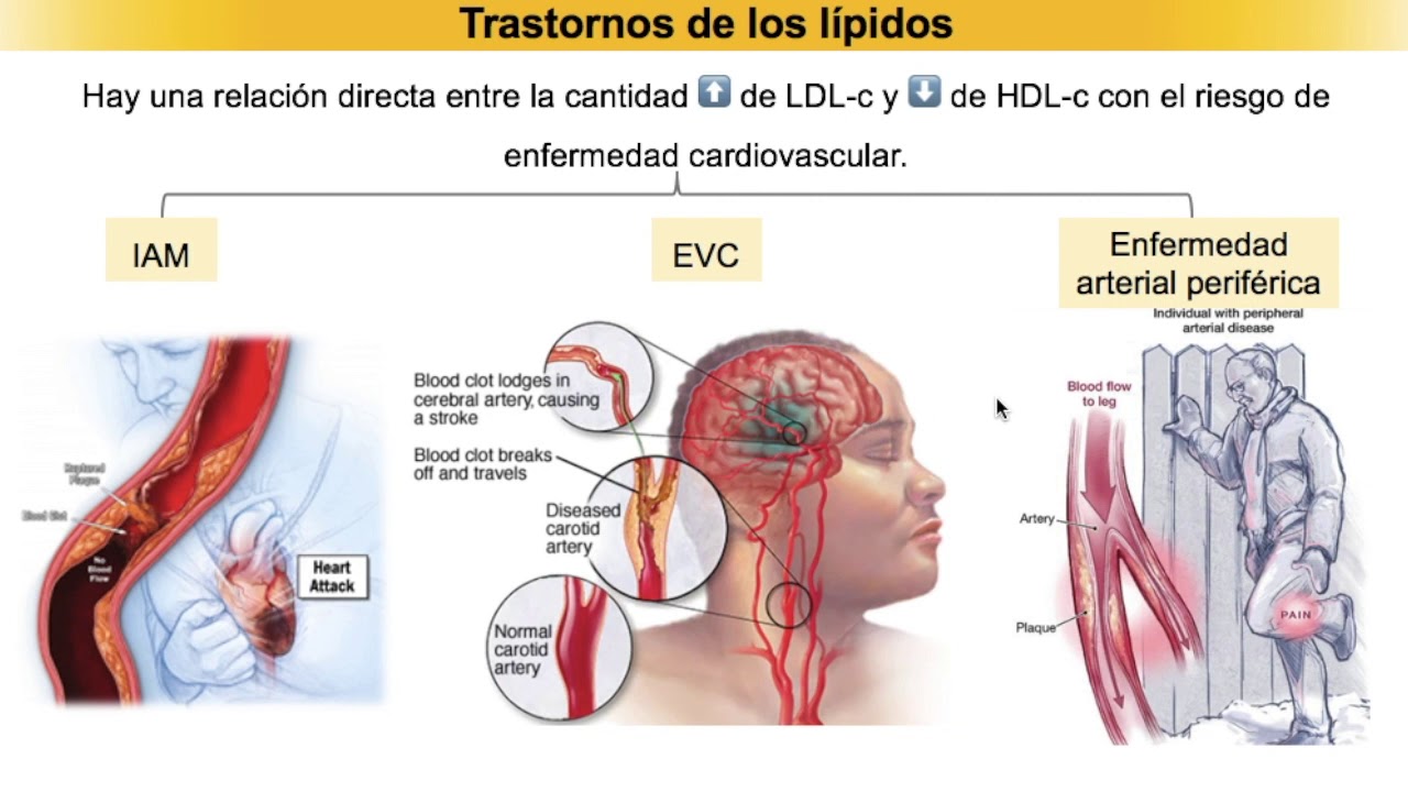 Tratamiento de dislipidemias