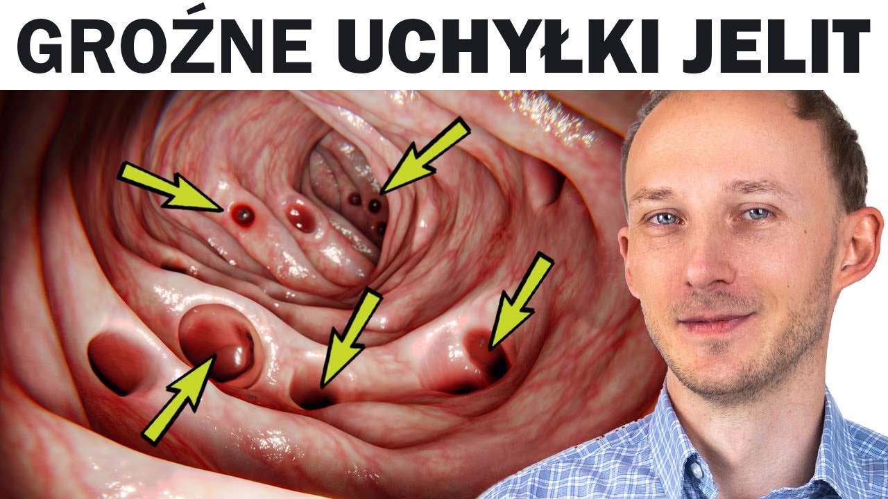 Choruje na to coraz więcej ludzi: UCHYŁKI JELIT i jak im zapobiec