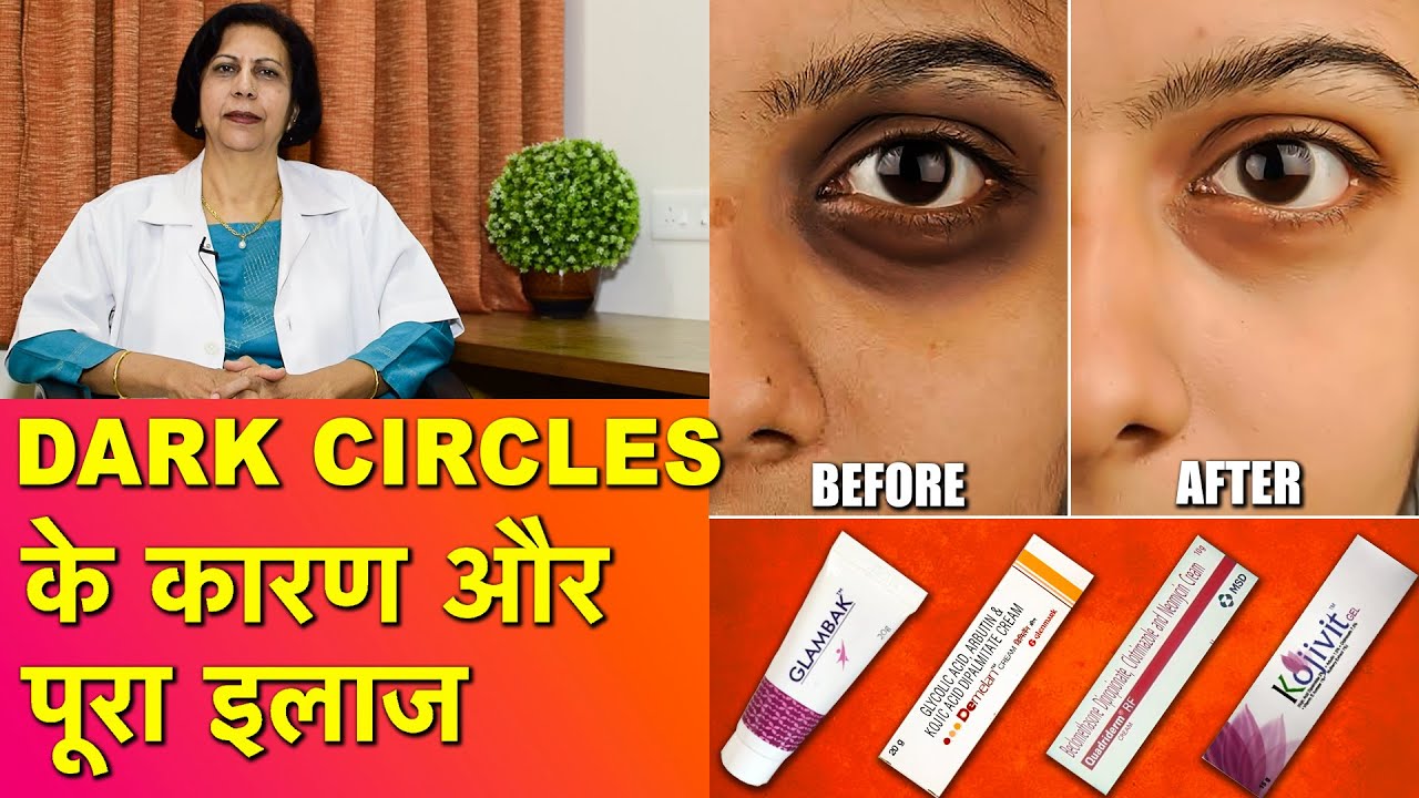 डार्क सर्कल / आँखों के काले घेरे के कारण और उनका ईलाज || Dark Circles Causes & Complete Treatment