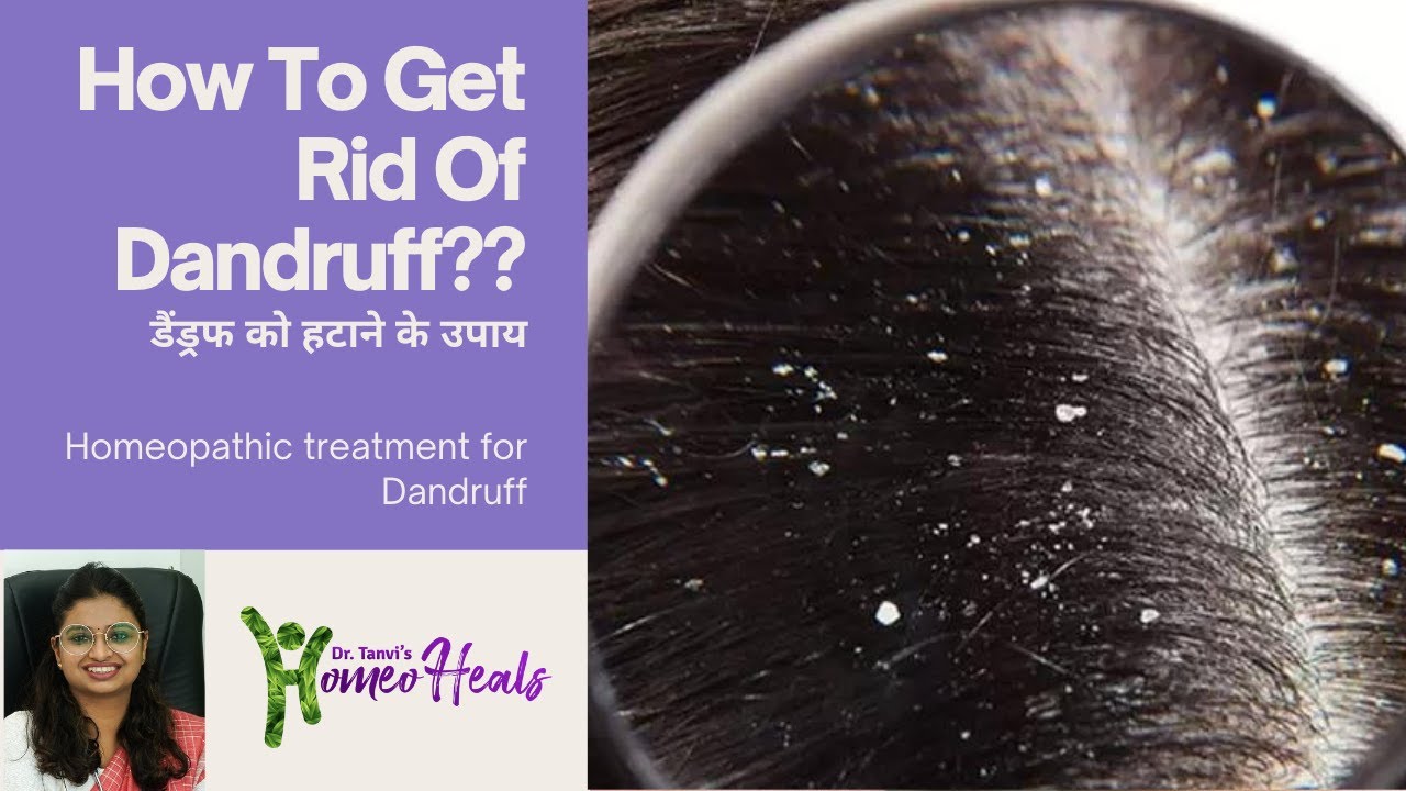 How To Get Rid Of Dandruff I Dandruff Homeopathic Medicine | Dandruff treatment in homeopathy