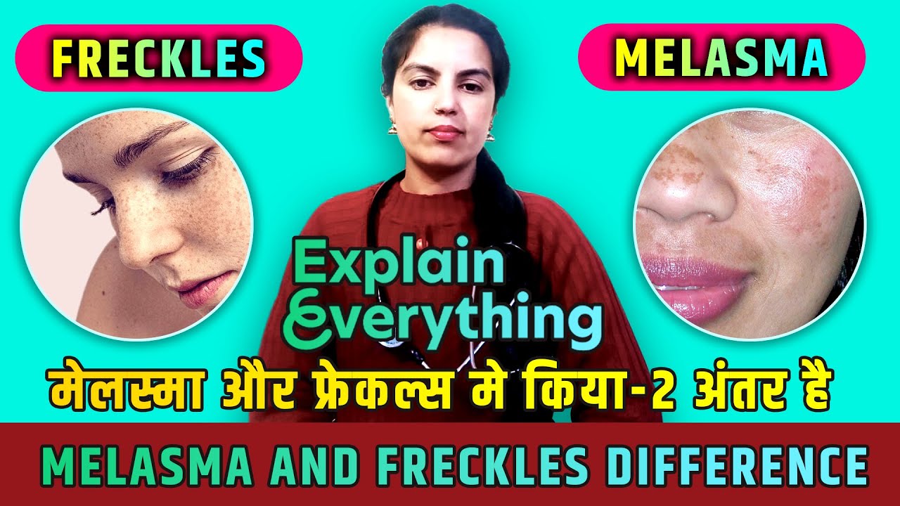 Melasma and Freckles differences | Melasma/Freckles/Hyperpigmentation