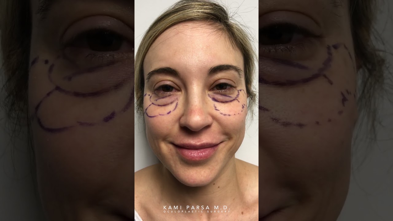 4 YEARS After Trifecta Lift with Dr. Kami  Parsa | Patient Testimonial