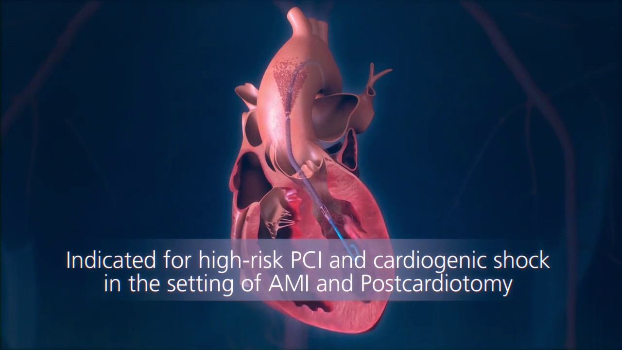 Impella® Heart Pump Animation: For Physicians