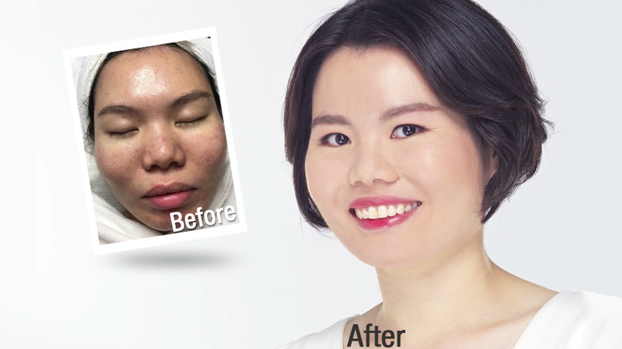 [Customer Review] -  How New York Skin Solutions Ended Her 10 Year Battle with Acne in 6 months!