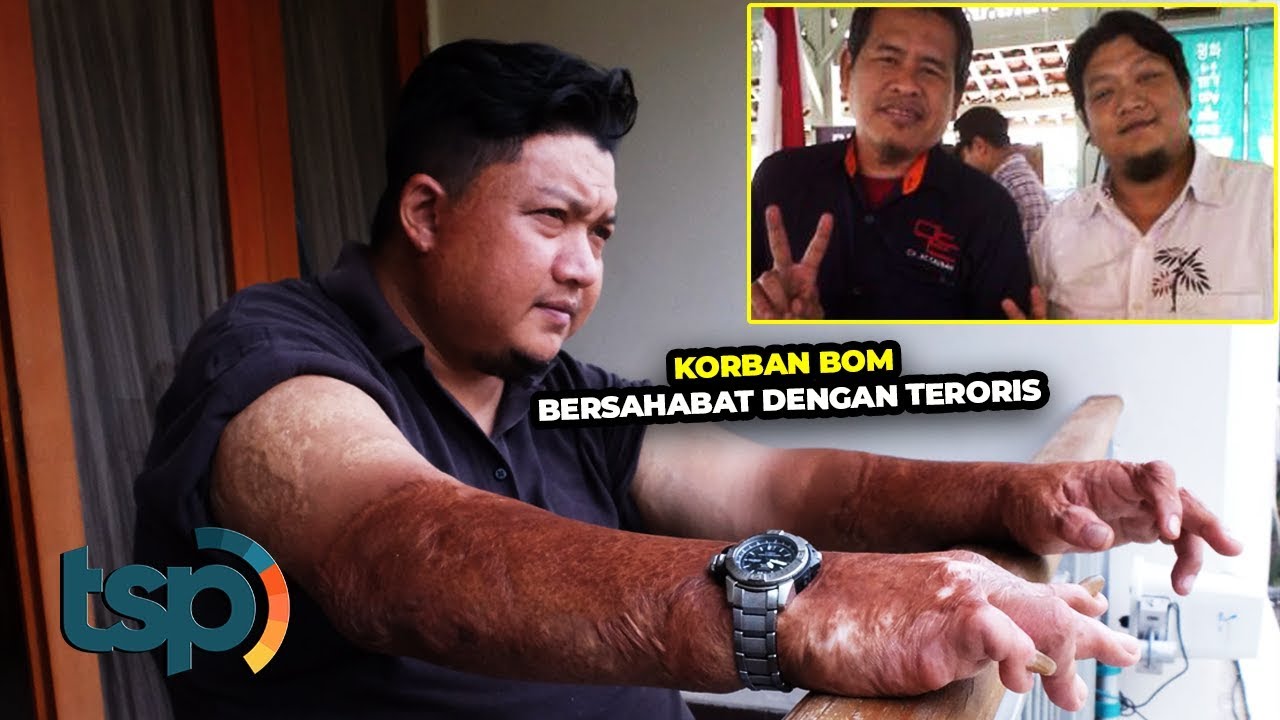 Mengharukan! Korban Bom Ini Ikhlas Memaafkan dan Malah Bersahabat Dengan Terosis!